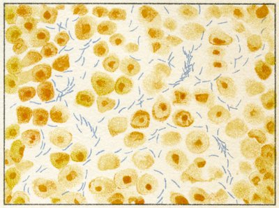 Tuberculosis Bacteria in Sputum by German School